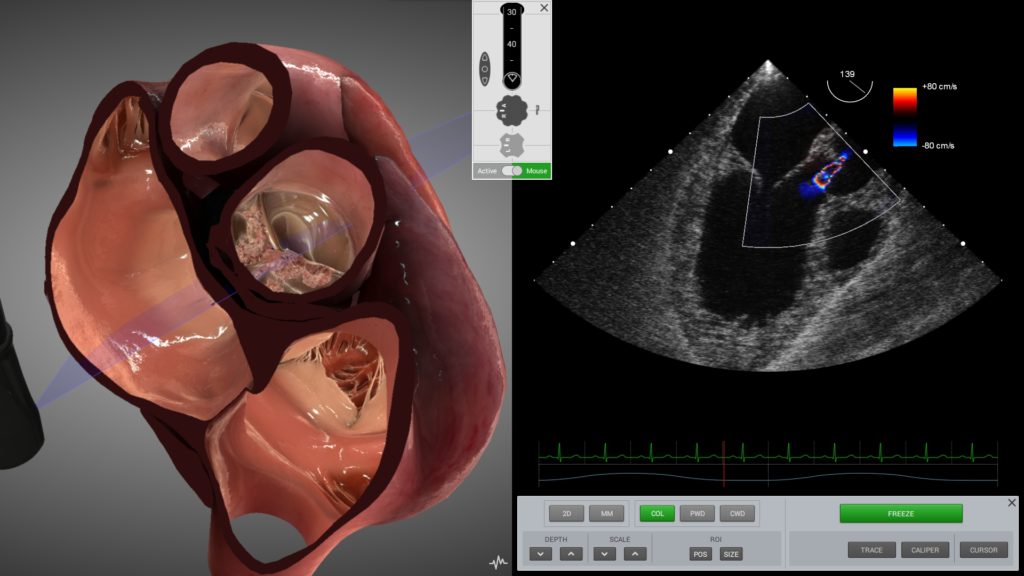 3d ultrasound of the heart